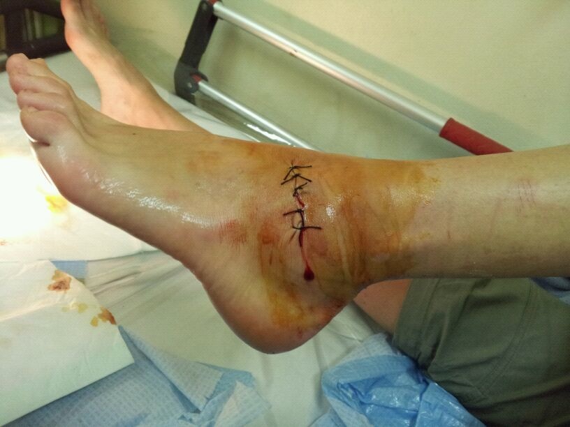 Some shocking stitches